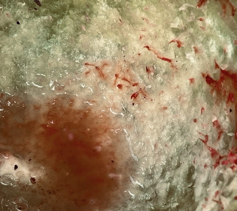 DISEASED CYST VERIFIABLE THANKS